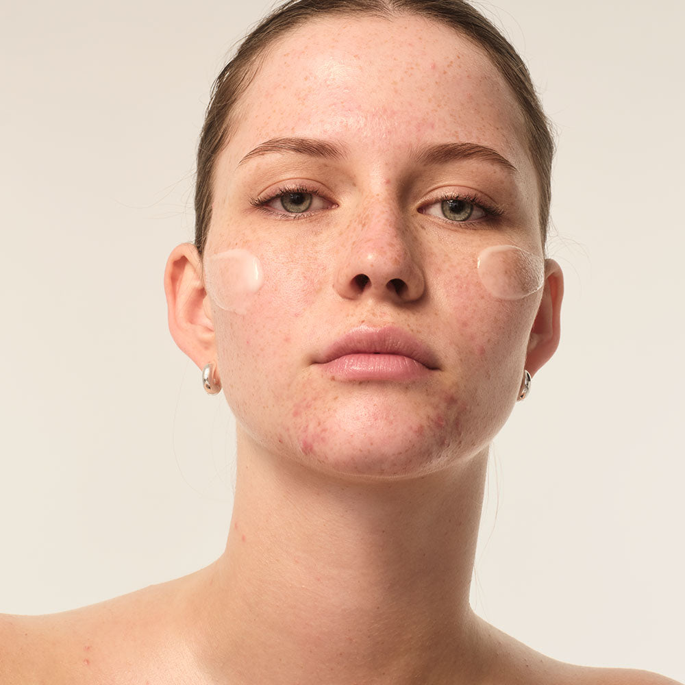 Eine Frau mit sichtbaren Hautunreinheiten trägt zwei transparente Pflegepatches auf ihren Wangen.