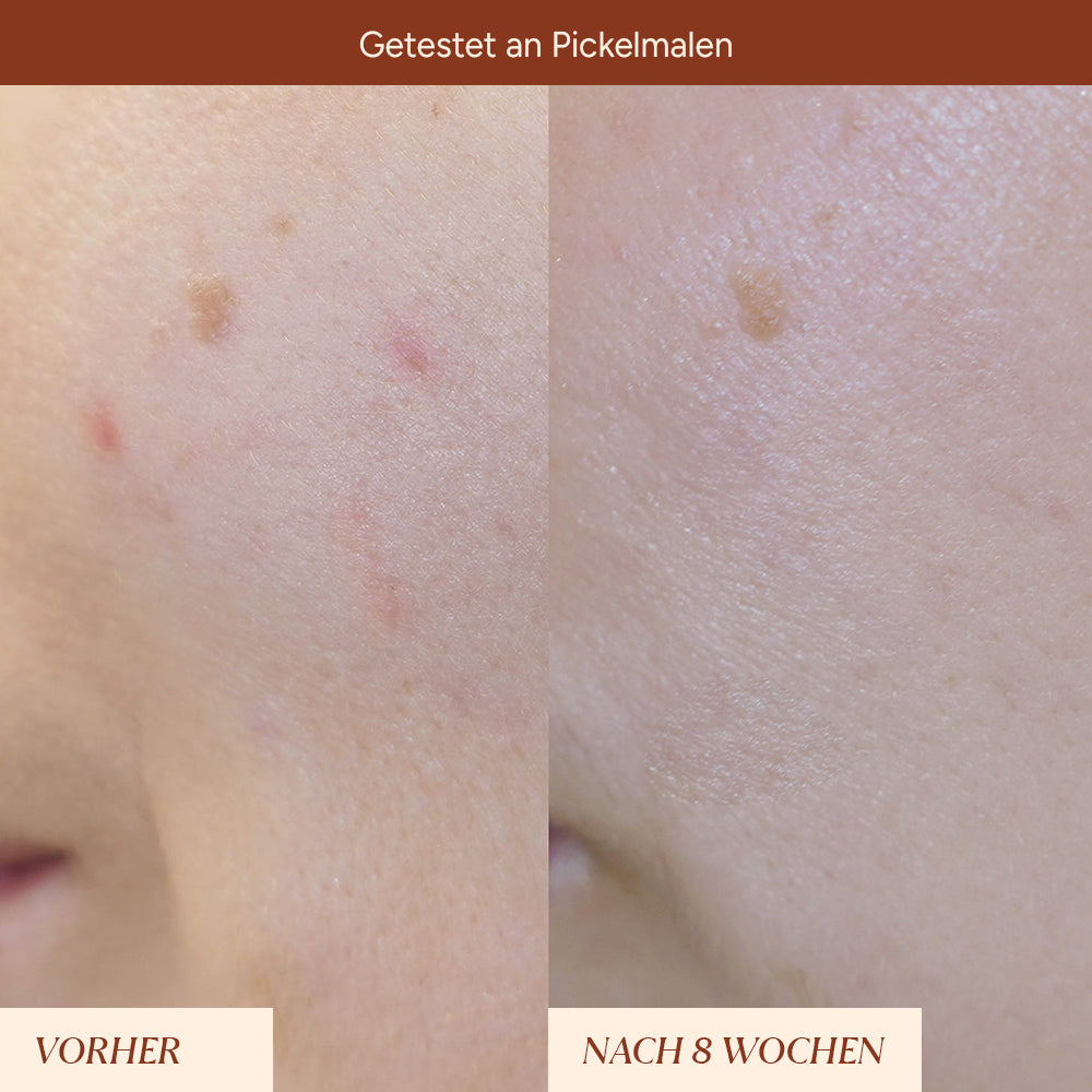 Vorher-Nachher-Bild einer Haut, die behandelt wurde. Links sind Rötungen und Pickelmale sichtbar, rechts eine verbesserte,