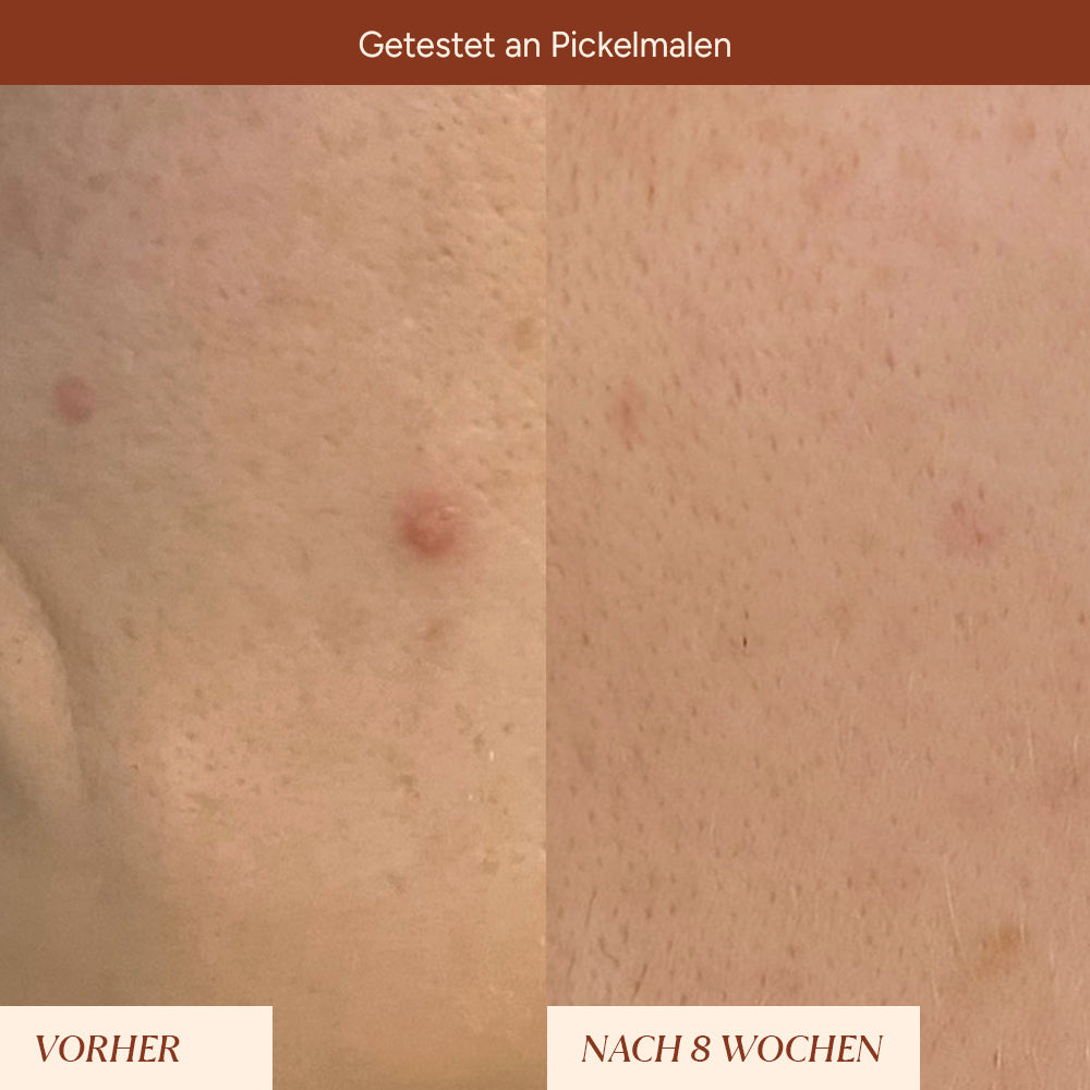 Vorher-Nachher-Vergleich der Hautoberfläche nach Anwendung. Links sichtbare Pickelmale, rechts deutlich reduzierte Rötungen.