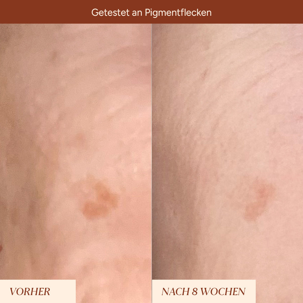 Vorher-Nachher Bild zu Pigmentflecken, zeigt den Hautzustand vor und nach 8 Wochen Anwendung.
