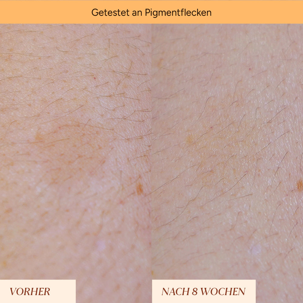 Vorher-Nachher Vergleich von Hautbereichen mit Pigmentflecken, sichtbar nach 8 Wochen Anwendung.