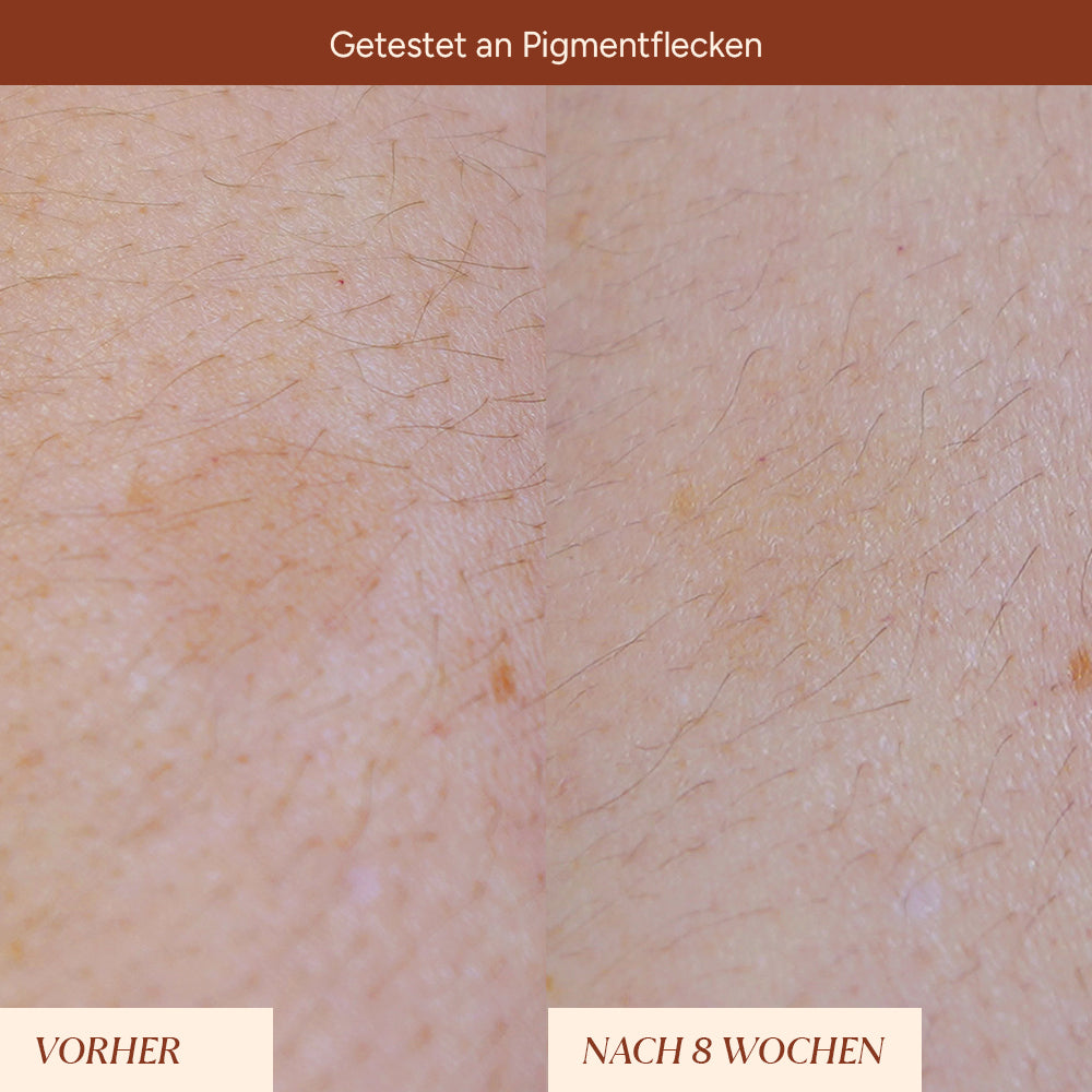 Vorher-Nachher Vergleich der Hautstellen mit Pigmentflecken. Links die unebene Hautstruktur, rechts sichtbar aufgehellt nach